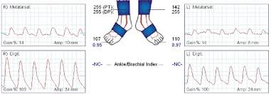 Toe Brachial Index