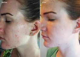 microdermabrasion before and after