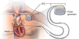 Icd's are implanted in patients with. Icd Crt Implantation Dr Tejas V Patel Cardiologist In Ahmedabad Cims