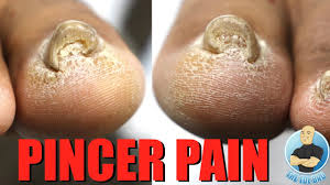 painful pincer toenails getting removed