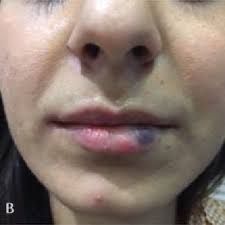 a bruising 2 hours after lip filler