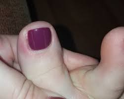 infection from pedicure page 2