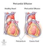 Image result for icd-10 code for pericardial effusion unspecified