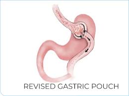 bariatric byp revision