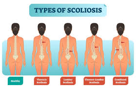 how to be confident with scoliosis