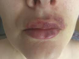 juvederm lip augmentation