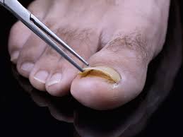 toenail fungus treatment atlanta