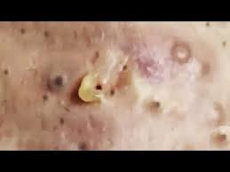 A video of a blackhead extraction is what got noticeable attention. Big Open Closed Blackheads Removal The Best Pimple Popping Videos Youtube