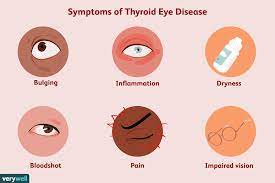 thyroid eye disease symptoms causes