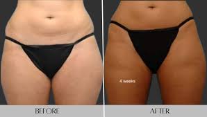 inner thigh liposuction cost results