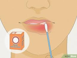 how to heal a swollen lip quickly 11