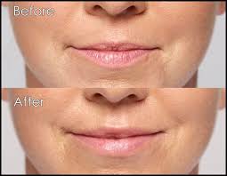 elysium skin laser thin lips