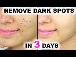 in 3 days remove dark spots black