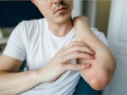 home remes to treat fungal infections