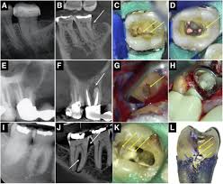 cbct patterns of bone loss and clinical