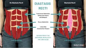diastasis recti what is it and what to