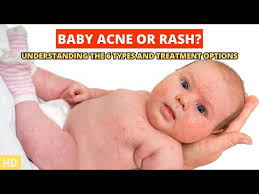 baby acne and rashes