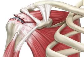 shoulder blade pain causes symptoms
