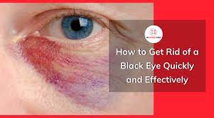 how to get rid of a black eye quickly