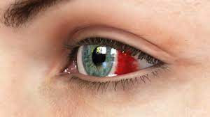 eye bleeding what you need to know