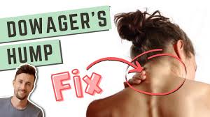 Dowager's Hump: 2 MUST-DO Things to Fix a Neck Hump - YouTube