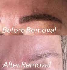 permanent makeup removal color