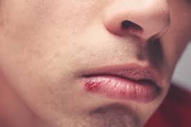 Setiap wanita tentunya menginginkan bibir yang merah, sayangnya tidak semua orang bisa mendapatkannya. Mengenali Herpes Di Bibir Dan Mulut Serta Cara Mengatasinya Alodokter