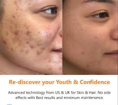 acne acne scars open pores