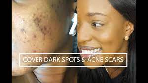 cover dark spots acne scars