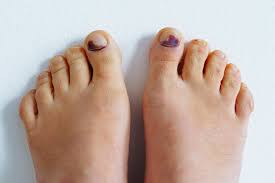 bruised toe images browse 1 009 stock