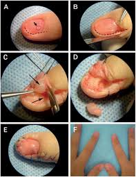 the treatment of finger glomus tumours