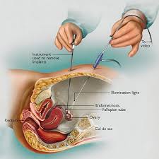 It manifests in three ways; Endometriosis Excision The Center For Innovative Gyn Care