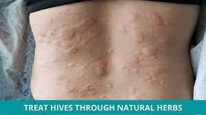 how to treat hives through natural herbs