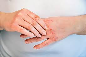 painful hands could be hand eczema
