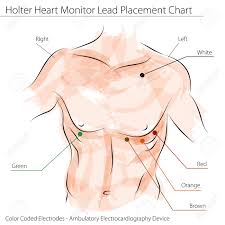 An Image Of A Holter Heart Monitor Lead Placement Chart
