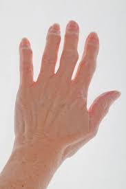 Most people with finger arthritis find warming the hands with a warm washcloth or under moderately hot water is most helpful at relieving the stiffness of arthritic fingers. Finger Arthritis Signs Symptoms And Treatment