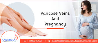 varicose veins during the course of