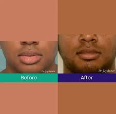 lip reduction cheiloplasty at best