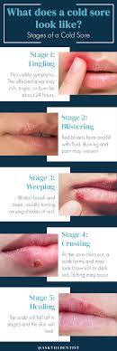 cold sores pictures symptoms causes