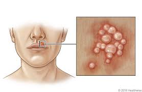 herpes simplex virus type 1 symptoms