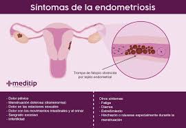Org the previous useless and immobile than sad. Endometriosis Causas Diagnostico Y Tratamiento Meditip