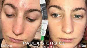 choice skincare results review