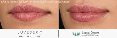 surrey lip injections lip filler