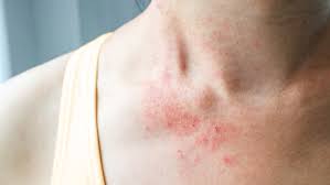what is eczema symptoms causes