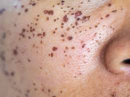 scabs on face causes treatment and