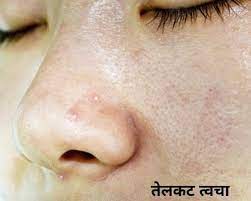 oily skin care tips in marathi त लकट