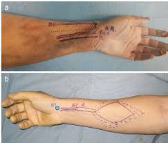The author performing isolated strength testing of the finger flexor tendons, which is helpful to differentiate fds vs. A Left Forearm Radial Artery Ra And Tendons Of Brachioradialis Download Scientific Diagram