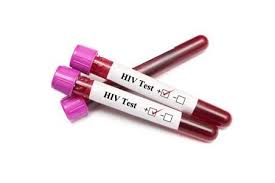 hiv positive symptoms treatment and