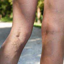 are spider veins anything to worry