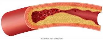 Image result for picture of arteriosclerosis